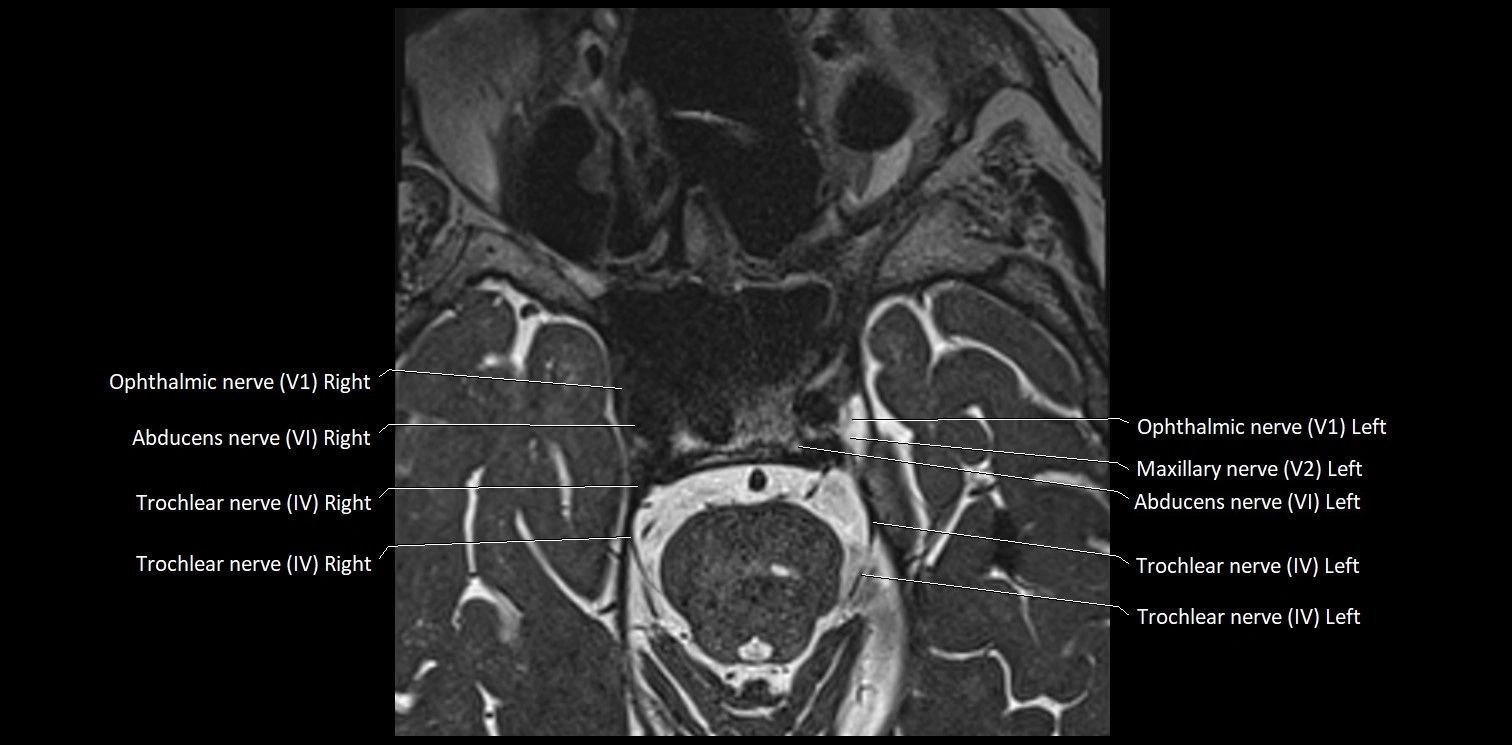 Cranial nerve anatomy axial MRI 3T image 36.webp